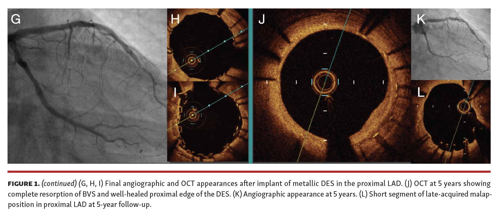 Final angiographic and OCT appearances after implant of metallic DES in the proximal LAD