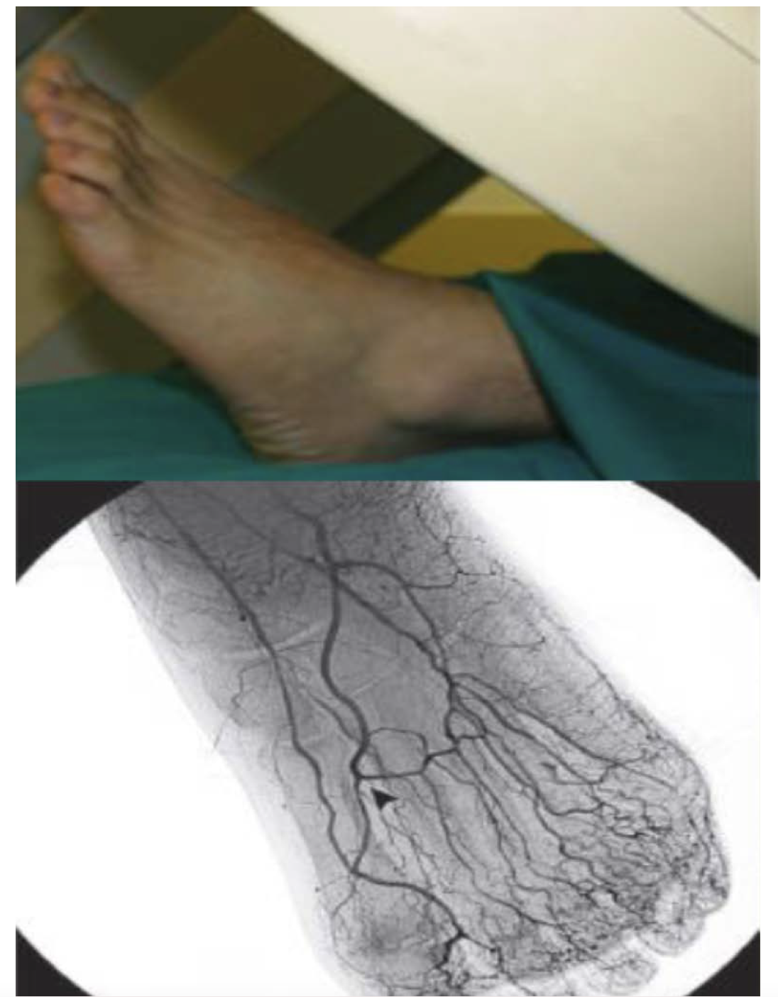 Figure 2. Upper view revealing the anterior-posterior  positioning of the image intensifier required to visualize the anterior pedal arch vessels directly and evaluate the distal branches into the foot and toes. Lower image revealing the angiographic view expected.