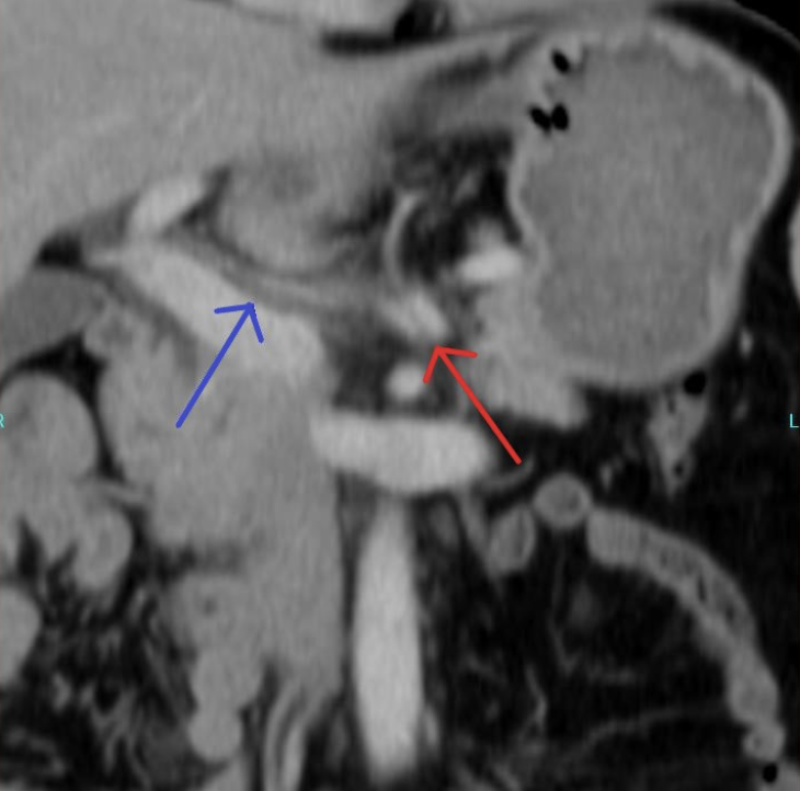 Figure 2. Red arrow shows splenic artery dissection; blue arrow shows common hepatic artery dissection.