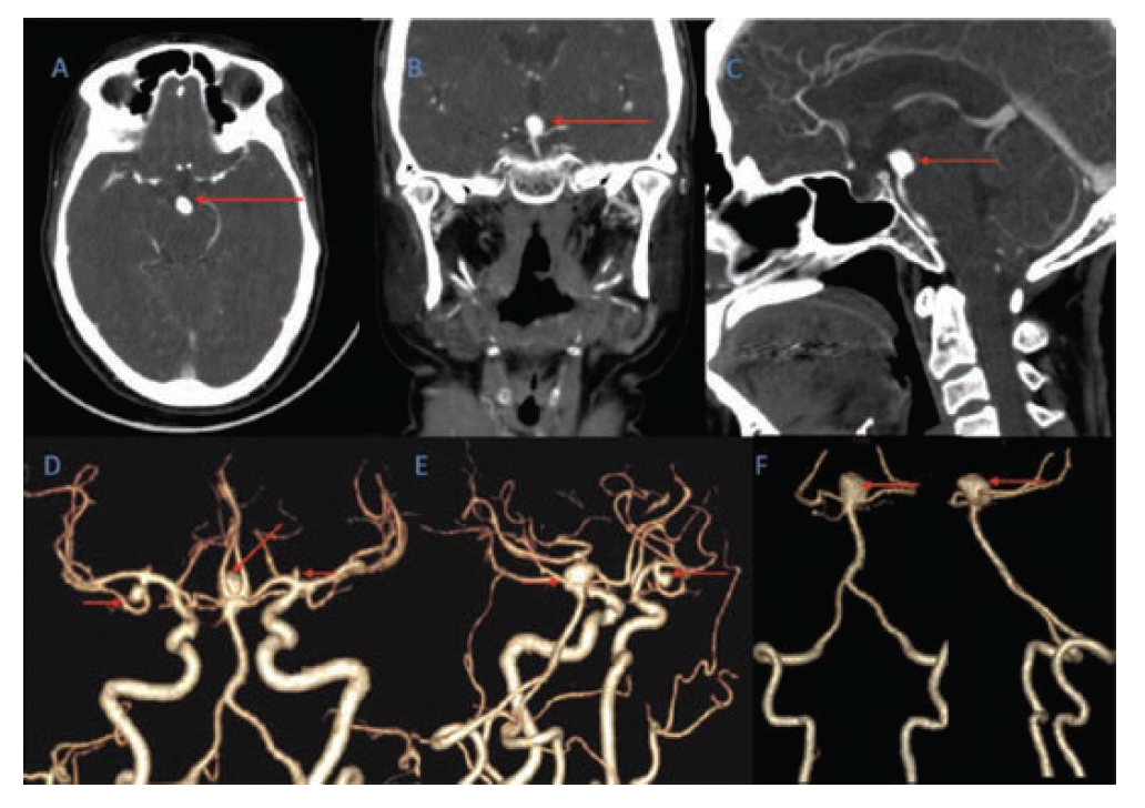 Figure 2. Contrast-enhanced CT of the brain with reconstructed images shows a basilar top aneurysm in the (A) axial, (B) coronal, and (C) sagittal planes. Reformatted images (D), (E),and (F) show other 2 aneurysms involving the inferior division of the right middle cerebral artery and the left A1 segment of the anterior cerebral artery.