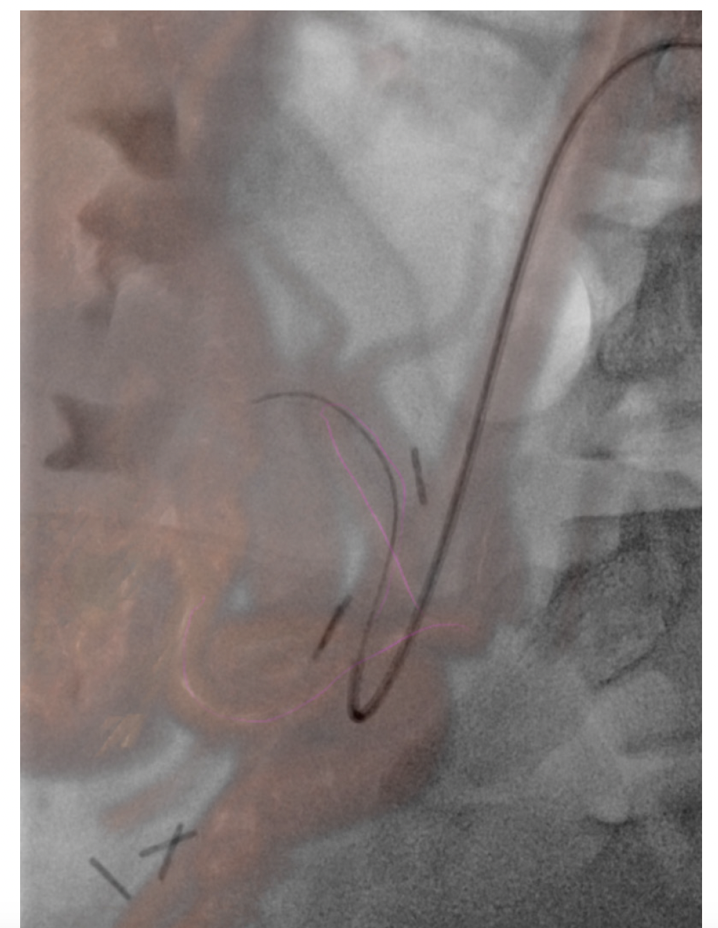 Figure 2. Using syngo Fusion, a 3D volume image (acquired using MR, CT, or syngo DynaCT) can be fused with live  2D fluoroscopy. The 3D image provides support better  understanding of complex anatomy and a roadmap of the vasculature to help guide catheter placement during treatment, without having to perform multiple contrast enhanced runs.