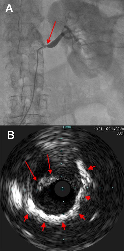 Figure 2.  Renal artery stenosis
