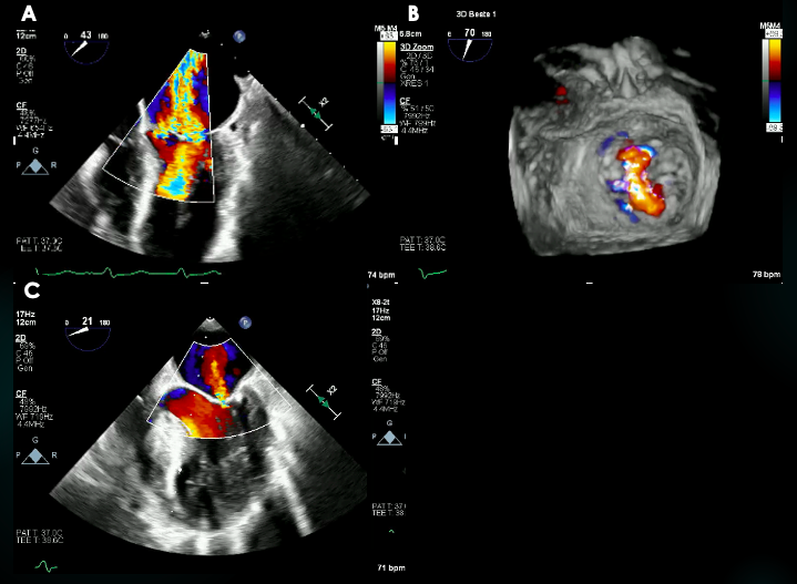 Figure 2. Transesophageal echocardiogram 