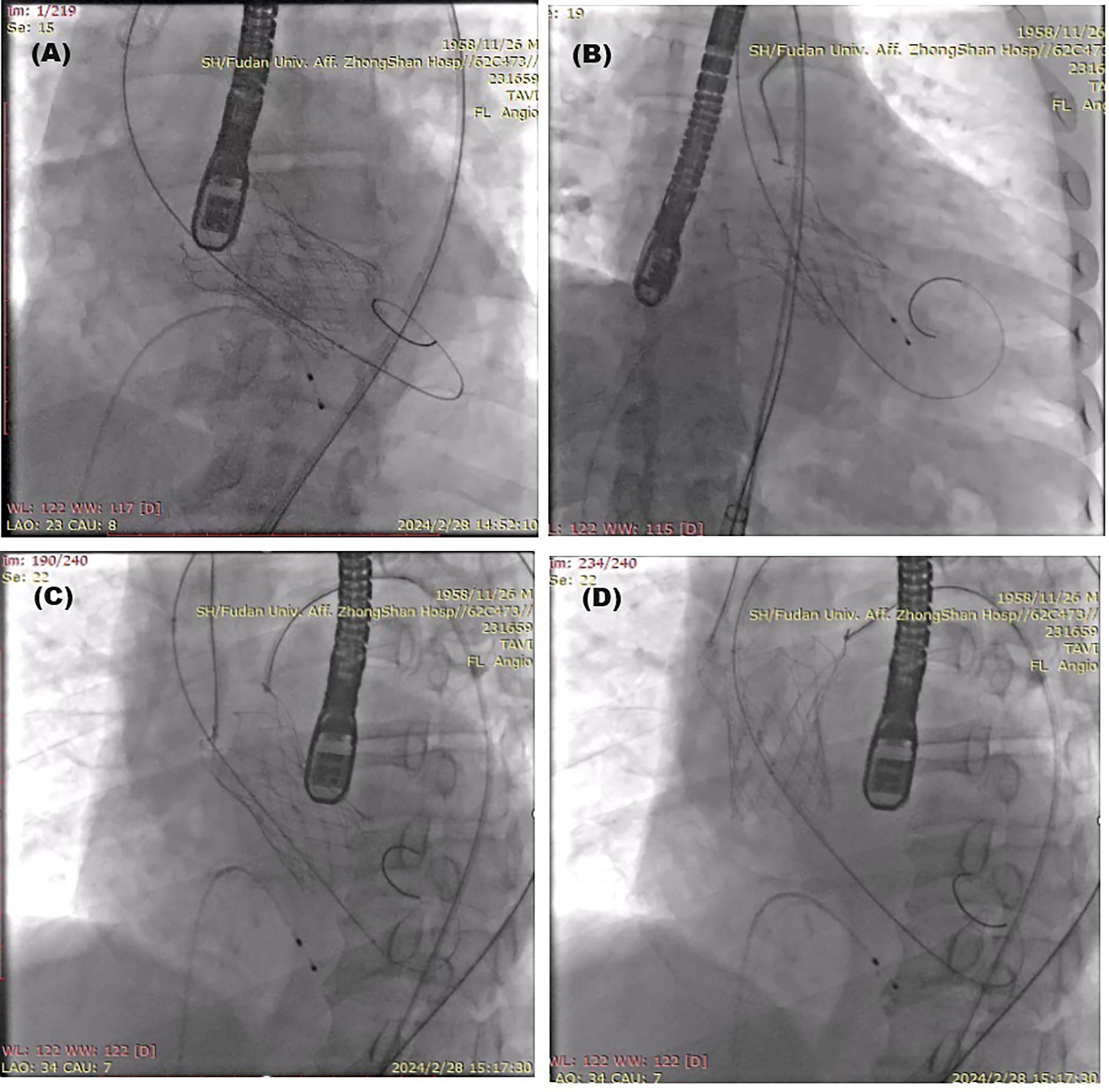 Figure 2. Remedy of a deep downward shift 