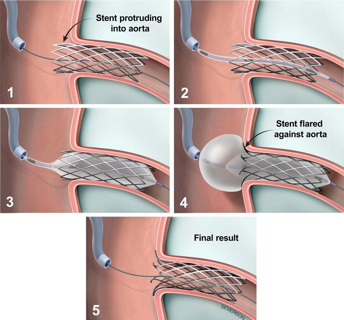 Figure 2. Illustration of the Ostial Flash balloon