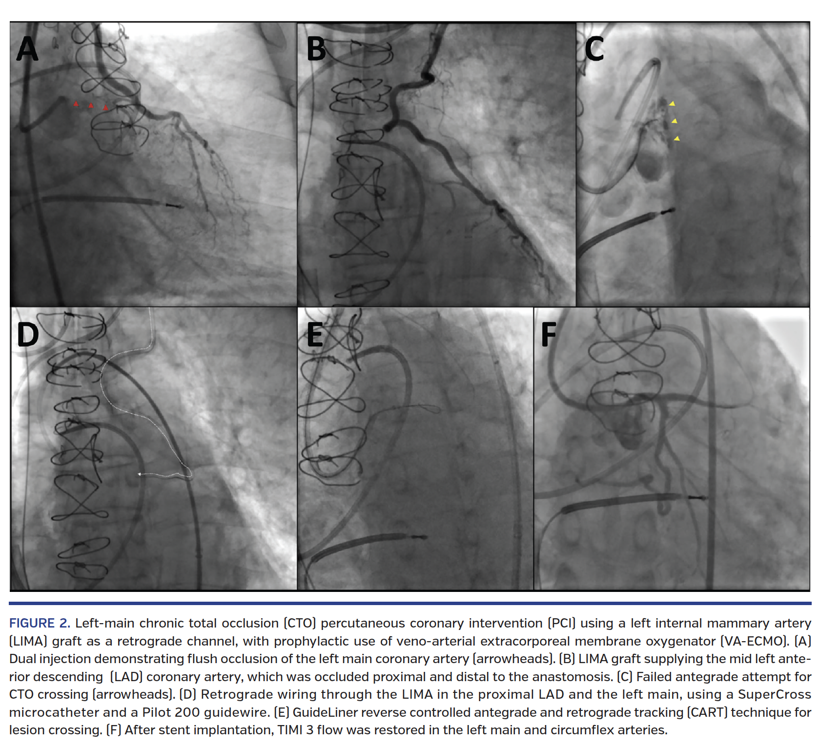 FIGURE 2. Left-main chronic total occlusion (CTO) percutaneous coronary intervention (PCI) using a left internal mammary artery (LIMA) graft as a retrograde channel, with prophylactic use of veno-arterial extracorporeal membrane oxygenator (VA-ECMO). (A) Dual injection demonstrating flush occlusion of the left main coronary artery (arrowheads). (B) LIMA graft supplying the mid left anterior descending (LAD) coronary artery, which was occluded proximal and distal to the anastomosis. (C) Failed antegrade attempt for CTO crossing (arrowheads). (D) Retrograde wiring through the LIMA in the proximal LAD and the left main, using a SuperCross microcatheter and a Pilot 200 guidewire. (E) GuideLiner reverse controlled antegrade and retrograde tracking (CART) technique for lesion crossing. (F) After stent implantation, TIMI 3 flow was restored in the left main and circumflex arteries.