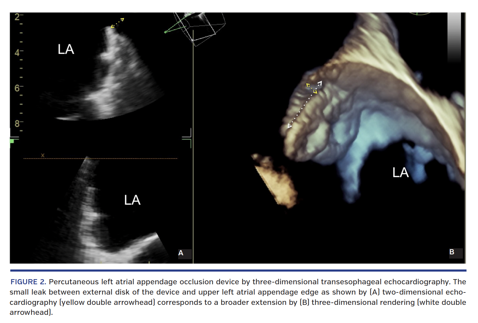 Percutaneous left atrial appendage occlusion device by three-dimensional transesophageal echocardiography. The small leak between external disk of the device and upper left atrial appendage edge