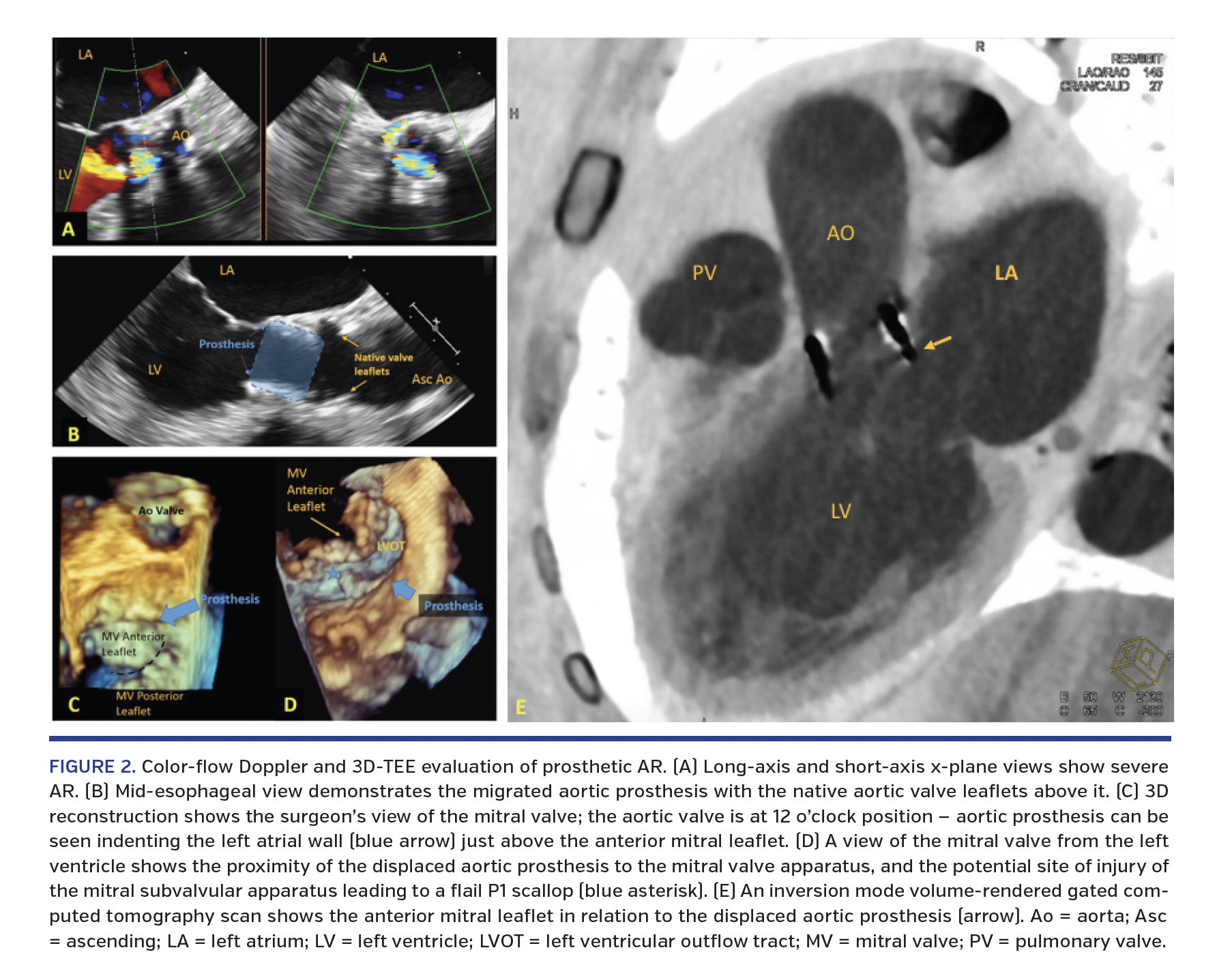 Vol. 30, No. 4, April 2018 E29 Very Late Migration of Ball oon-Expandabl e Valv e KALRA, et al. FIGURE 2. Color-flow Doppler and 3D-TEE evaluation of prosthetic AR.