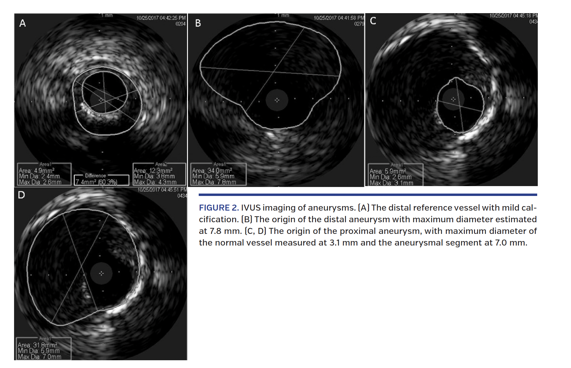 FIGURE 2. IVUS imaging of aneurysms. (A) The distal reference vessel with mild calcification. (B) The origin of the distal aneurysm with maximum diameter estimated at 7.8 mm. (C, D) The origin of the proximal aneurysm, with maximum diameter of the normal vessel measured at 3.1 mm and the aneurysmal segment at 7.0 mm.