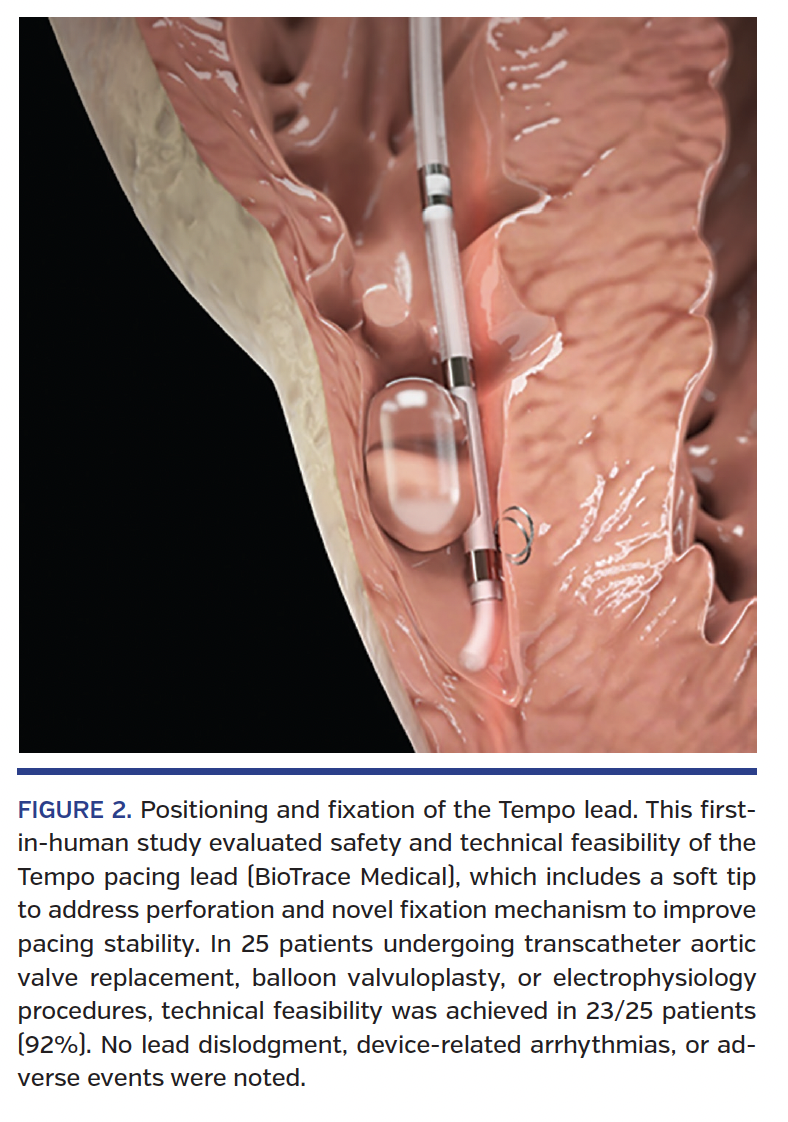 FIGURE 2. Positioning and fixation of the Tempo lead. This firstin- human study evaluated safety and technical feasibility of the Tempo pacing lead (BioTrace Medical), which includes a soft tip to address perforation and novel fixation mechanism to improve pacing stability. In 25 patients undergoing transcatheter aortic valve replacement, balloon valvuloplasty, or electrophysiology procedures, technical feasibility was achieved in 23/25 patients (92%). No lead dislodgment, device-related arrhythmias, or adverse events were noted.