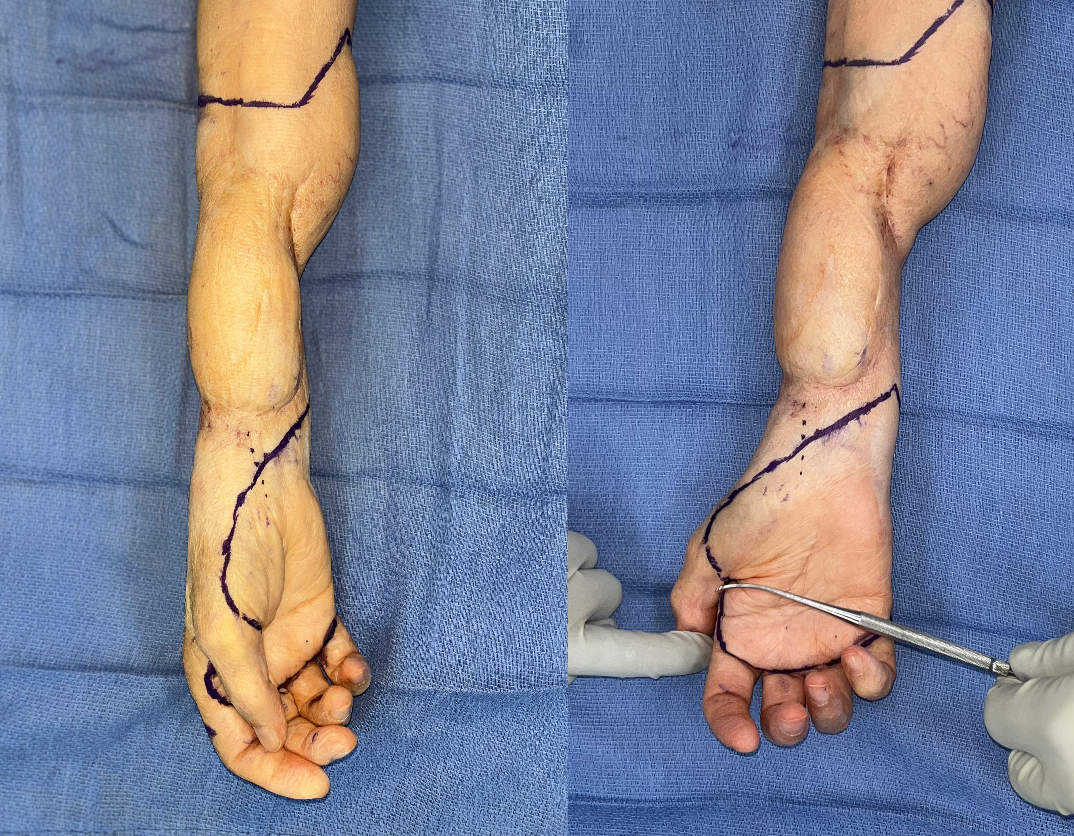 Figure 2: Surgical markings for the palmar free filet flap.