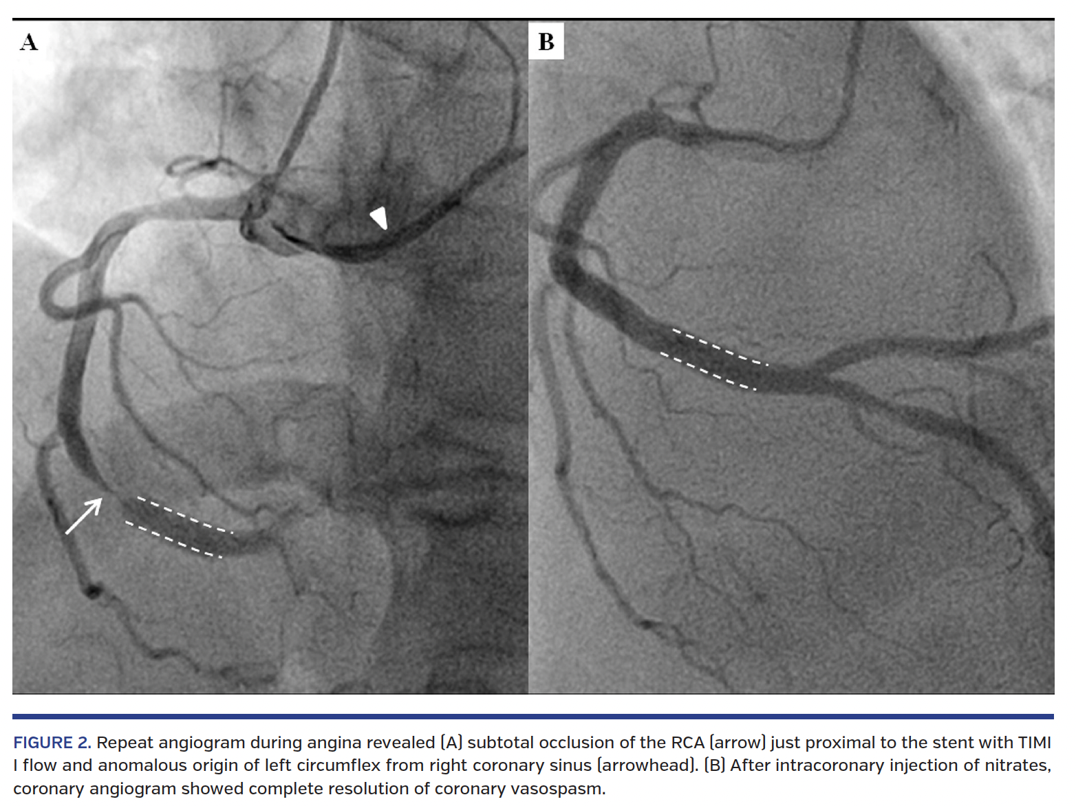 FIGURE 2. Repeat angiogram during angina revealed (A) subtotal occlusion of the RCA (arrow) just proximal to the stent with TIMI I flow and anomalous origin of left circumflex from right coronary sinus (arrowhead). (B) After intracoronary injection of nitrates, coronary angiogram showed complete resolution of coronary vasospasm.