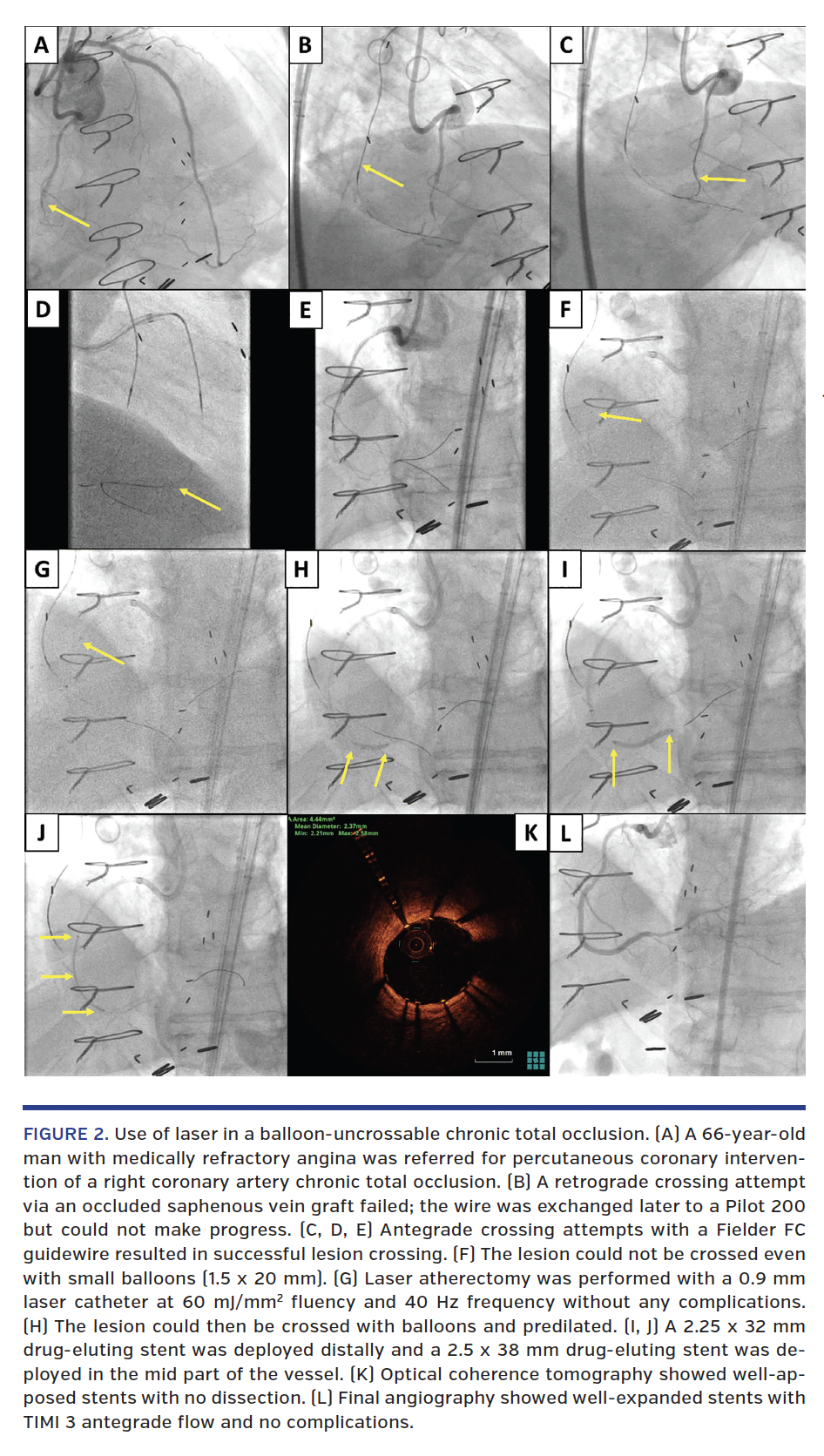 FIGURE 2. Use of laser in a balloon-uncrossable chronic total occlusion.