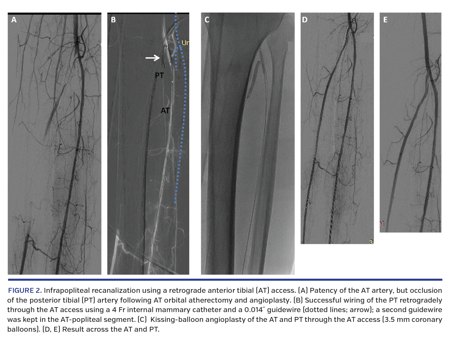 Infrapopliteal recanalization using a retrograde anterior tibial (AT) access.