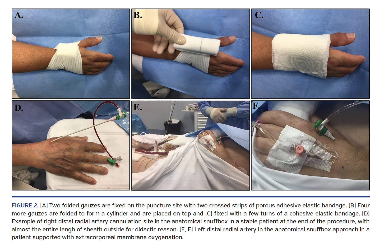 FIGURE 2. (A) Two folded gauzes are fixed on the puncture site with two crossed strips of porous adhesive elastic bandage. (