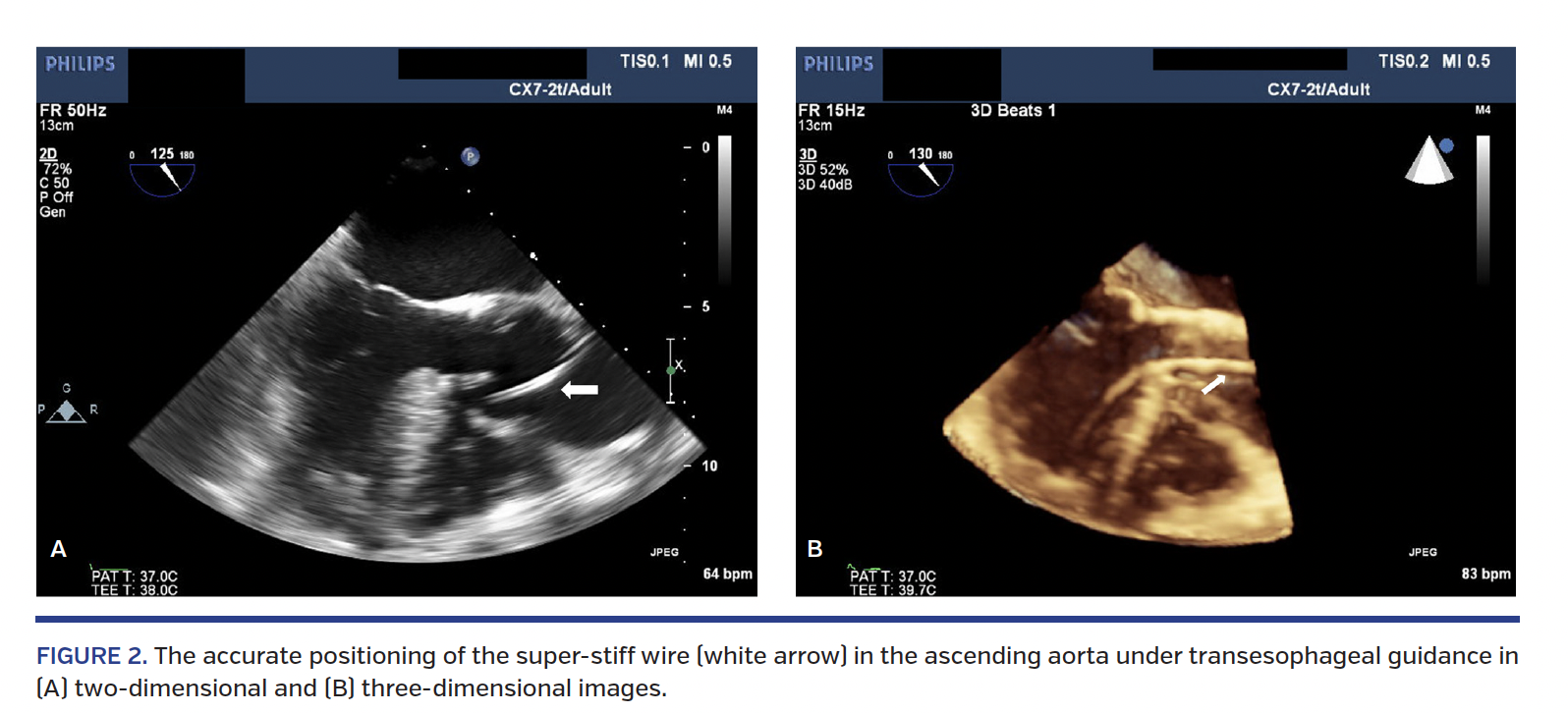 FIGURE 2. The accurate positioning of the super-stiff wire (white arrow) in the ascending aorta under transesophageal guidance in (A) two-dimensional and (B) three-dimensional images.