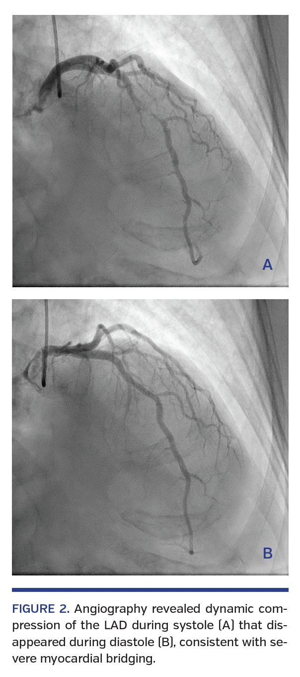 FIGURE 2. Angiography revealed dynamic compression of the LAD during systole (A) that disappeared during diastole (B), consistent with severe myocardial bridging.