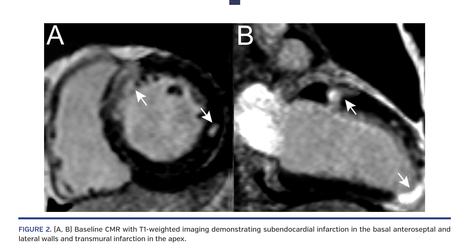 FIGURE 2. (A, B) Baseline CMR with T1-weighted imaging demonstrating subendocardial infarction in the basal anteroseptal and lateral walls and transmural infarction in the apex.