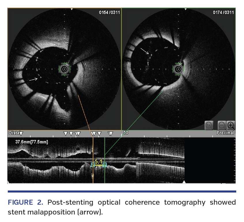 FIGURE 2. Post-stenting optical coherence tomography showed stent malapposition (arrow).