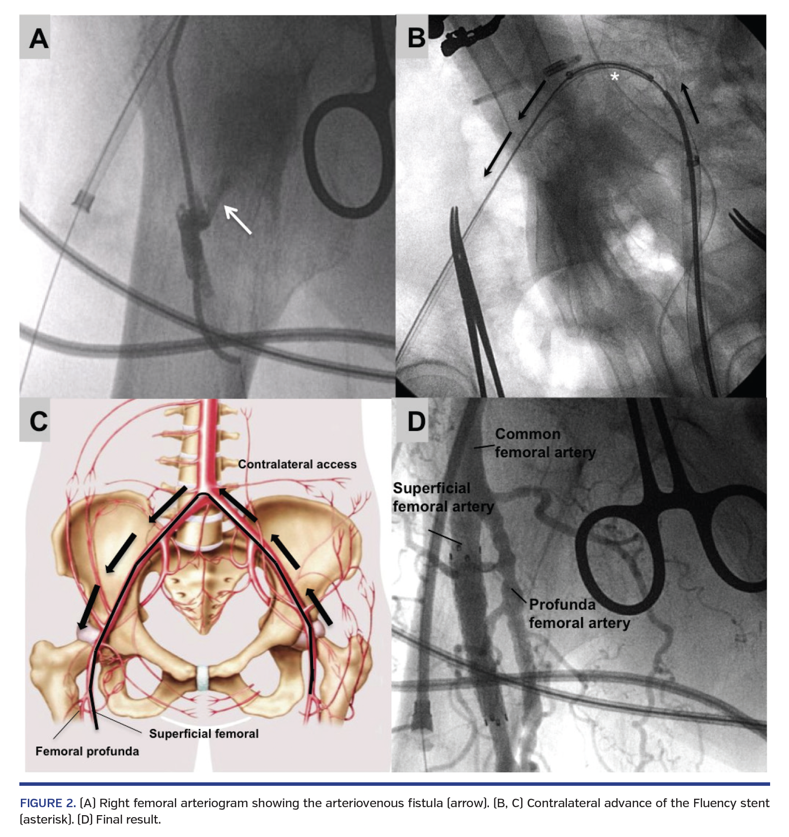 FIGURE 2. (A) Right femoral arteriogram showing the arteriovenous fistula (arrow). (B, C) Contralateral advance of the Fluency stent (asterisk). (D) Final result.