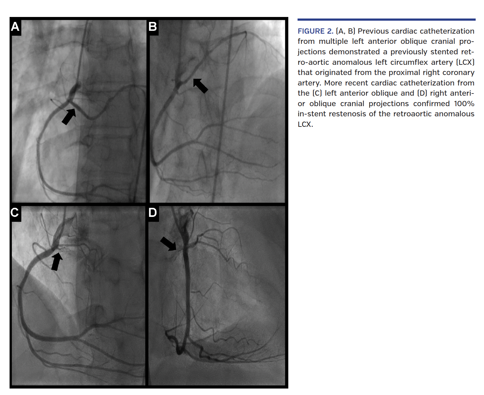 FIGURE 2. (A, B) Previous cardiac catheterization from multiple left anterior oblique cranial projections demonstrated a previously stented retro- aortic anomalous left circumflex artery (LCX) that originated from the proximal right coronary artery. More recent cardiac catheterization from the (C) left anterior oblique and (D) right anterior oblique cranial projections confirmed 100% in-stent restenosis of the retroaortic anomalous LCX.