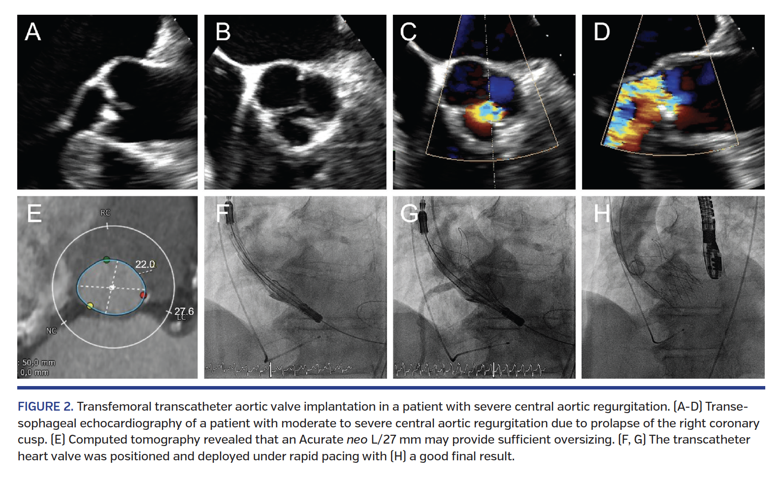 FIGURE 2. Transfemoral transcatheter aortic valve implantation in a patient with severe central aortic regurgitation