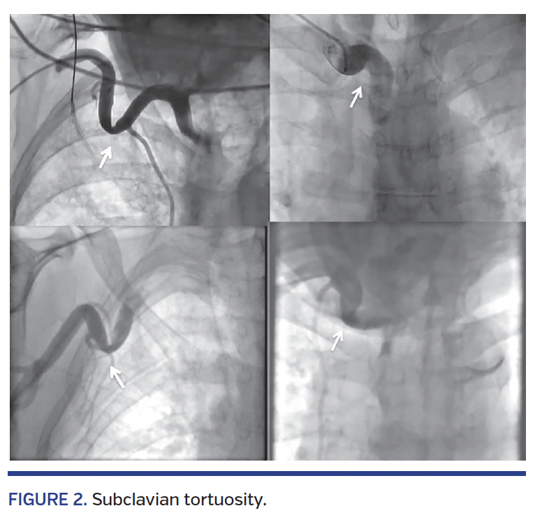 FIGURE 2. Subclavian tortuosity.