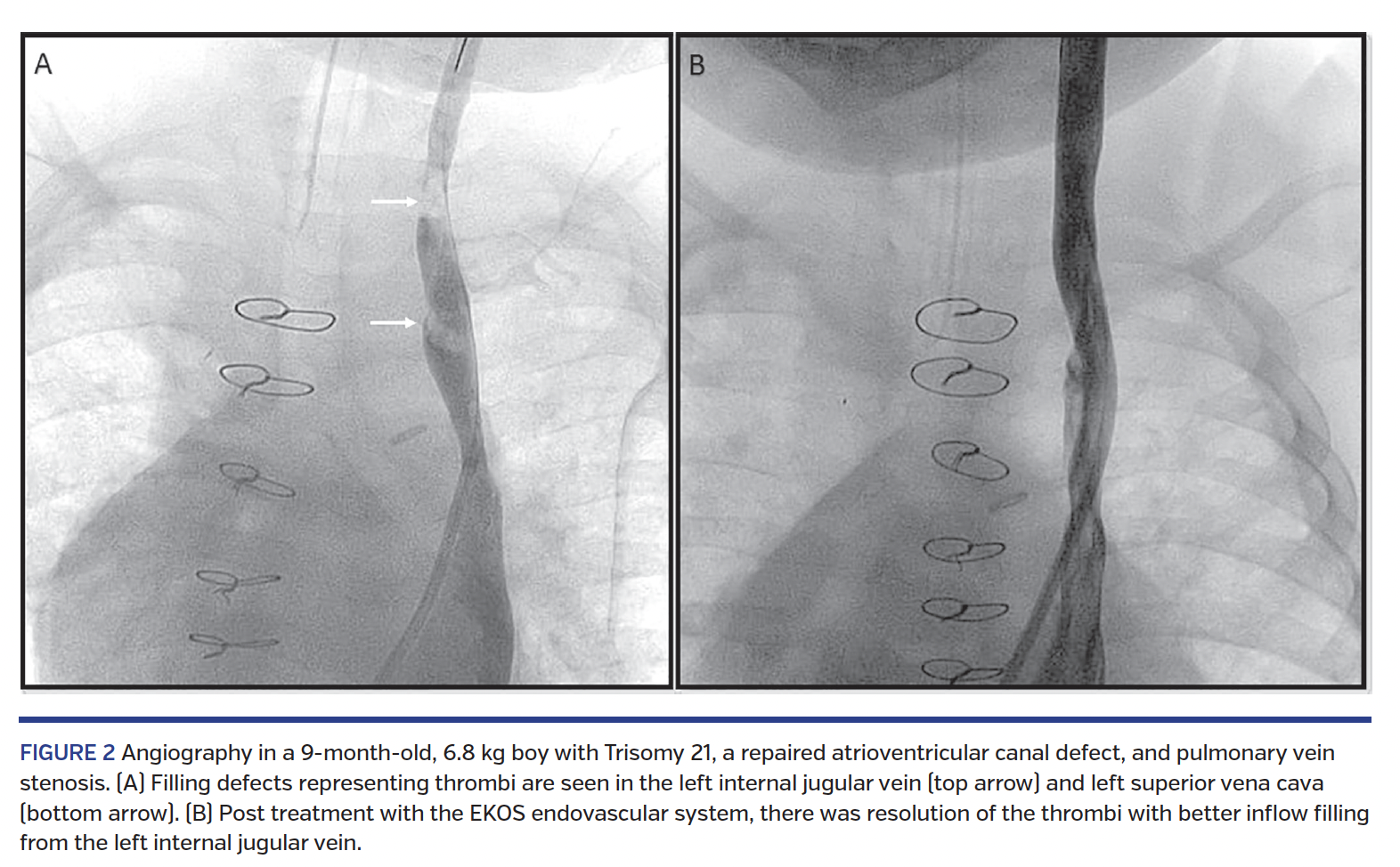 FIGURE 2 Angiography in a 9-month-old, 6.8 kg boy with Trisomy 21, a repaired atrioventricular canal defect, and pulmonary vein stenosis. (A) Filling defects representing thrombi are seen in the left internal jugular vein (top arrow) and left superior vena cava (bottom arrow). (B) Post treatment with the EKOS endovascular system, there was resolution of the thrombi with better inflow filling from the left internal jugular vein.
