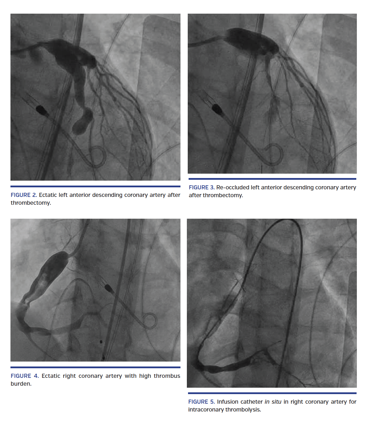 Ectatic left anterior descending coronary artery after thrombectomy.