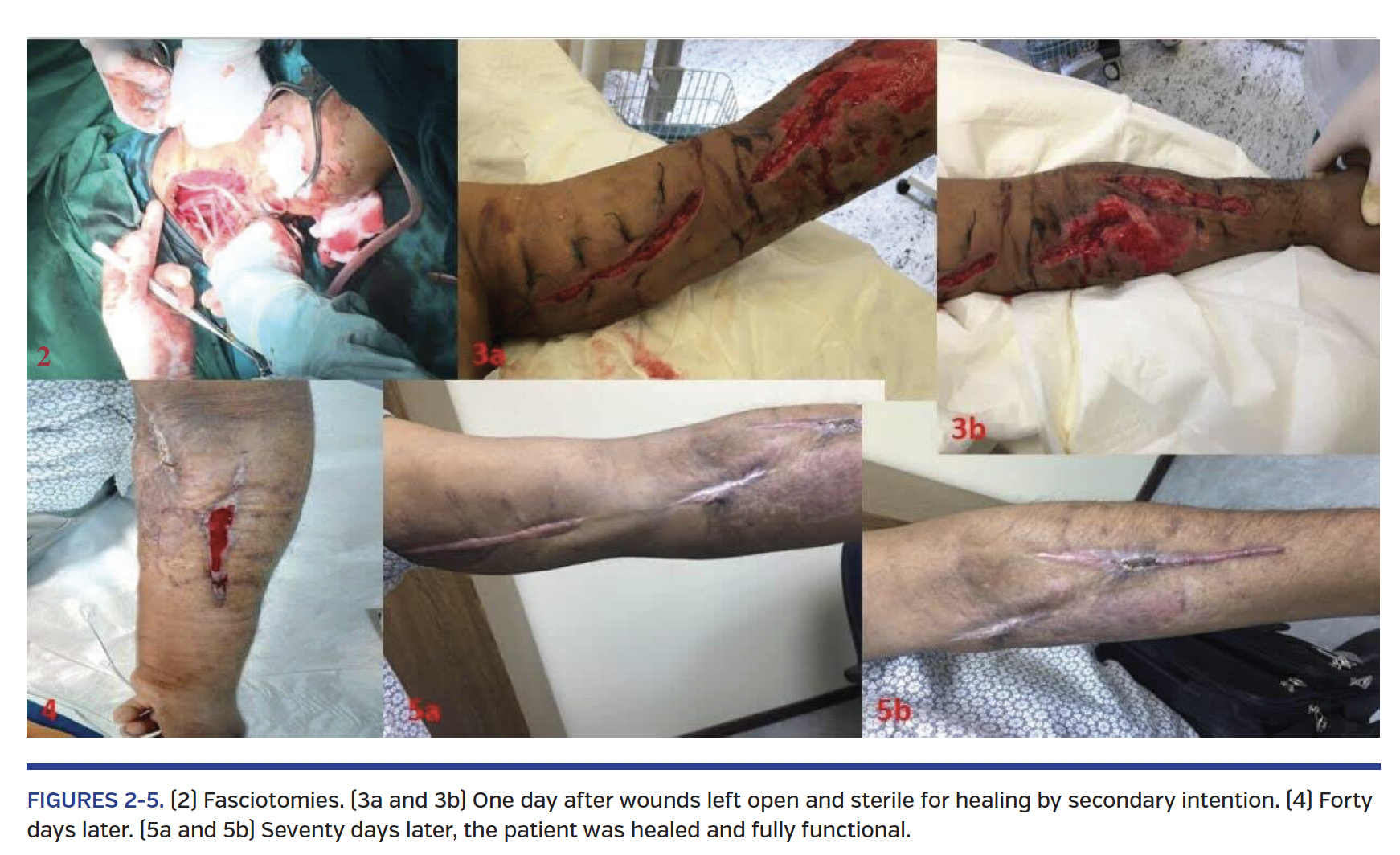 FIGURES 2-5. (2) Fasciotomies. (3a and 3b) One day after wounds left open and sterile for healing by secondary intention. (4) Forty days later. (5a and 5b) Seventy days later, the patient was healed and fully functional.