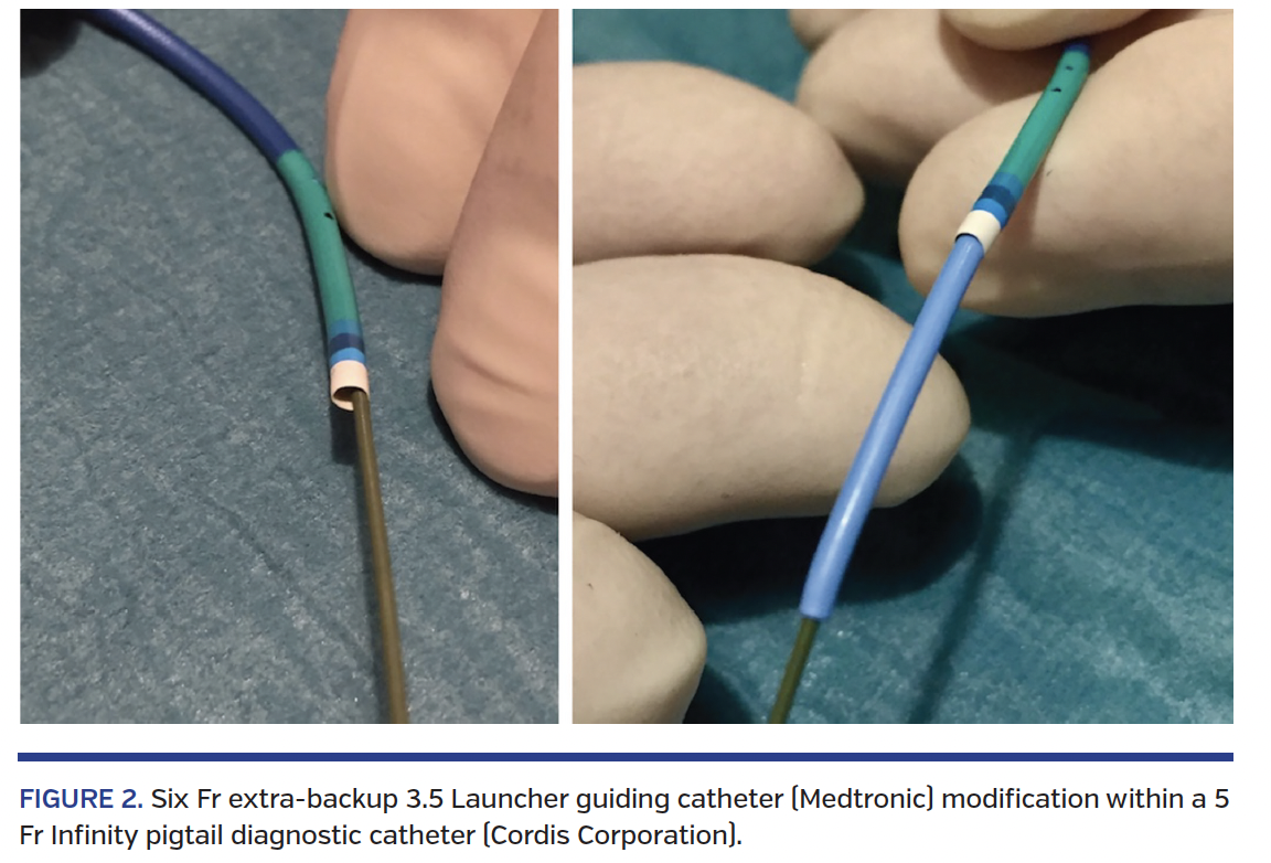 FIGURE 2. Six Fr extra-backup 3.5 Launcher guiding catheter (Medtronic) modification within a 5 Fr Infinity pigtail diagnostic catheter (Cordis Corporation).