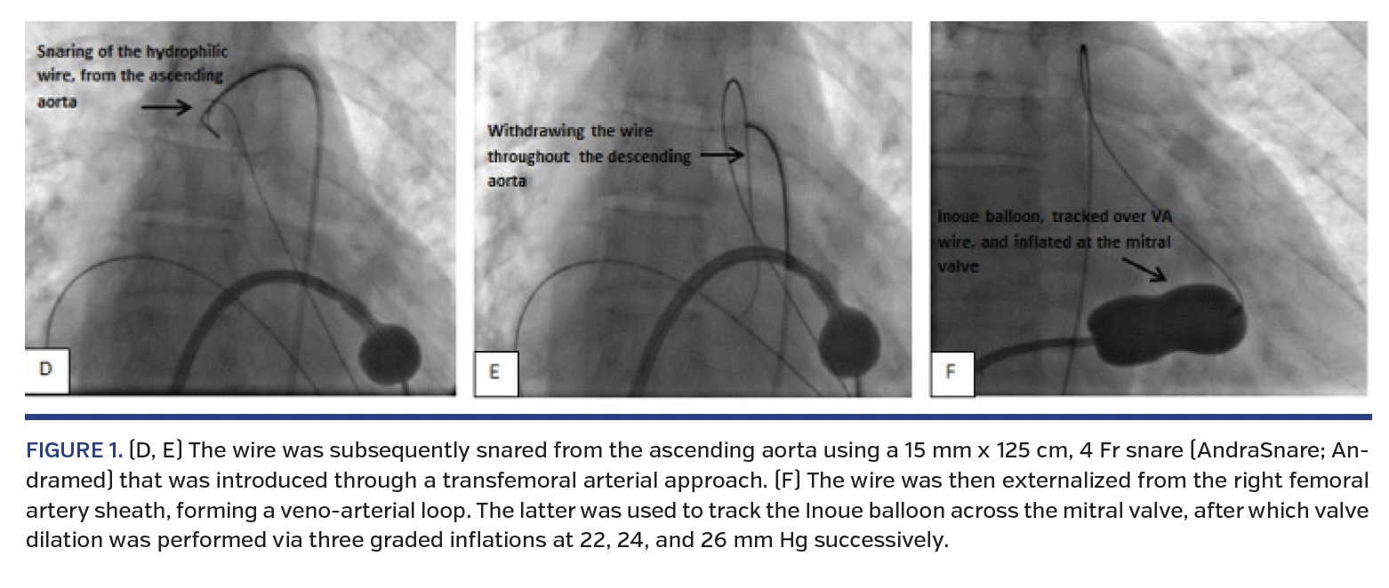 The wire was subsequently snared from the ascending aorta using a 15 mm x 125 cm, 4 Fr snare
