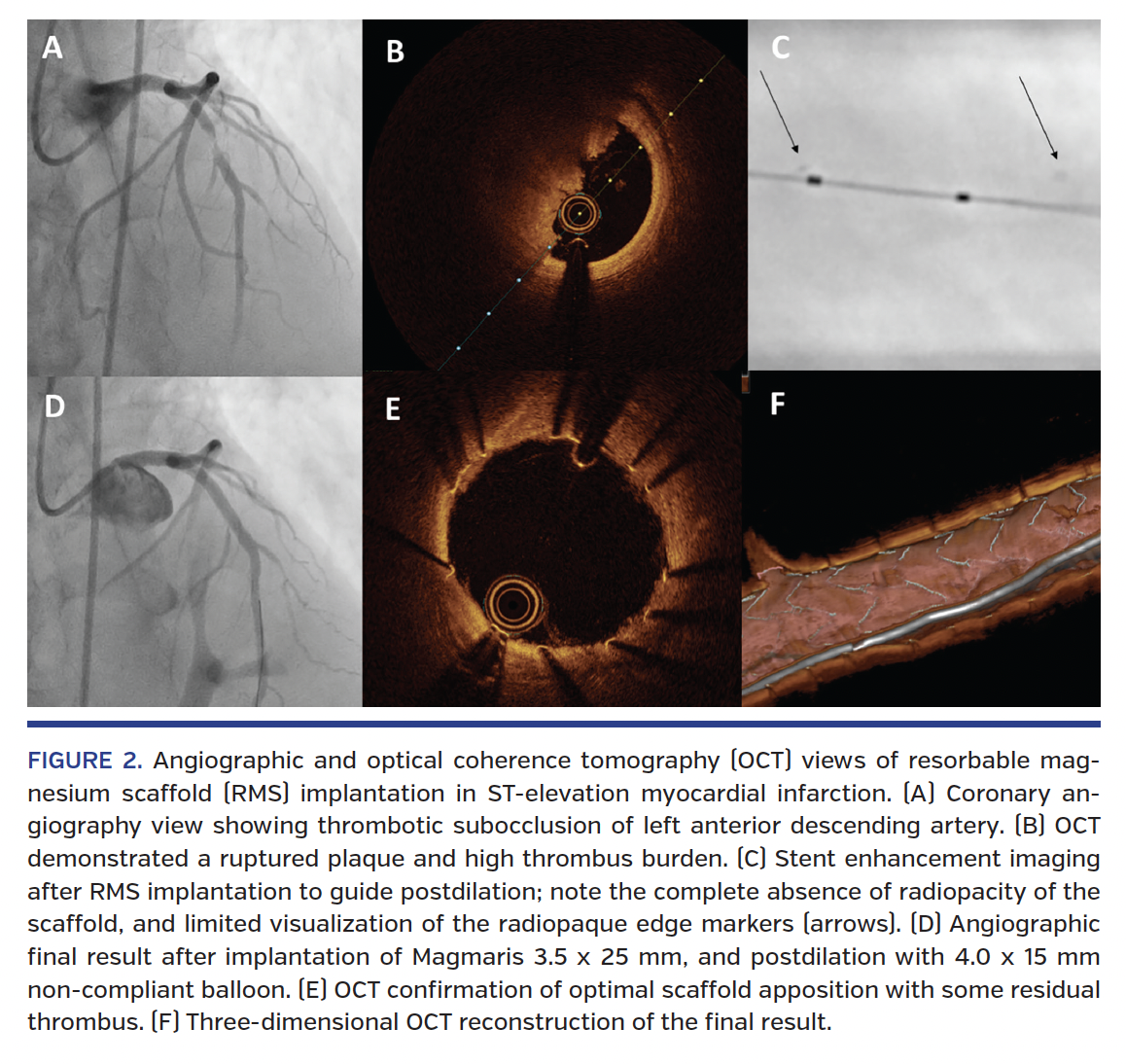 FIGURE 2. Angiographic and optical coherence tomography (OCT) views of