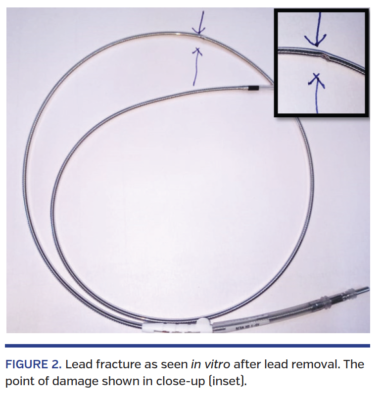 FIGURE 2. Lead fracture as seen in vitro after lead removal. The point of damage shown in close-up (inset).