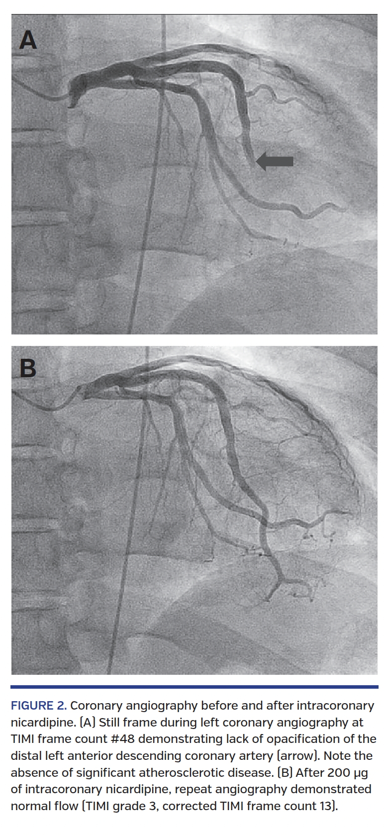 FIGURE 2. Coronary angiography before and after intracoronary nicardipine.