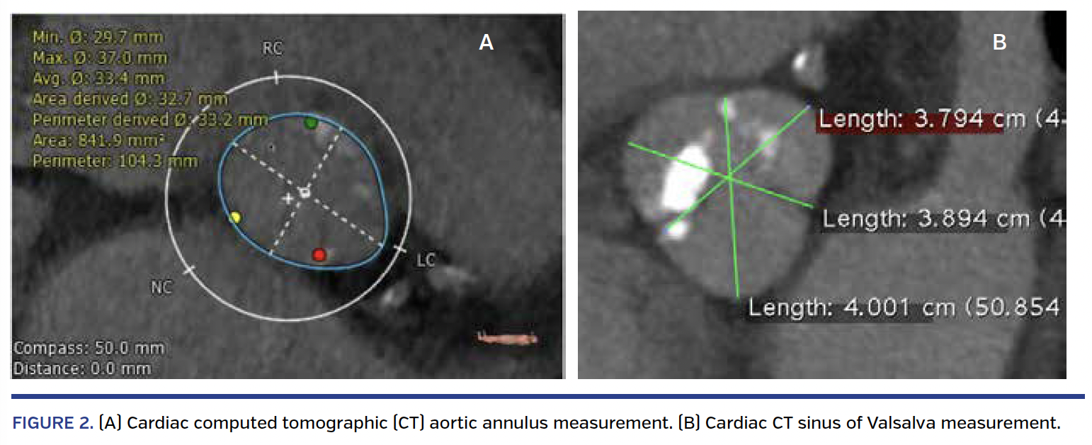 FIGURE 2. (A) Cardiac computed tomographic (CT) aortic annulus measurement. (B) Cardiac CT sinus of Valsalva measurement