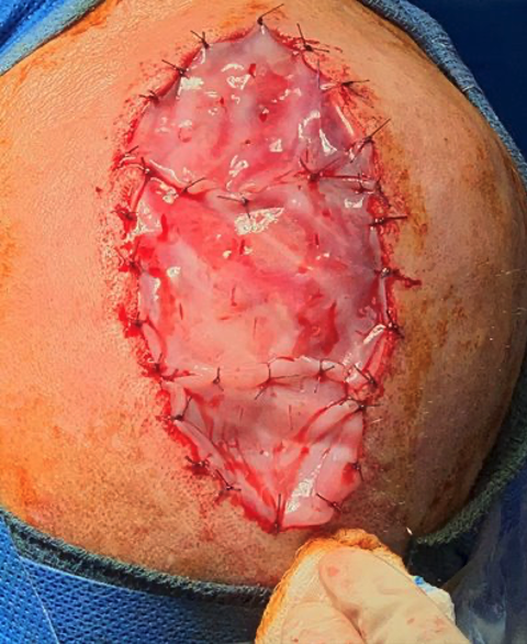 Intraoperative placement of stravix tissue, day 10
