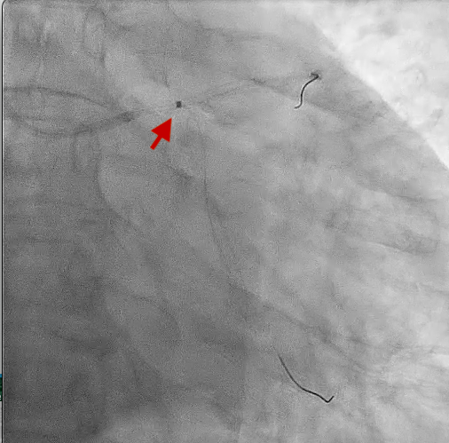 Figure 2. Fluoroscopy showed the ELCA coronary laser atherectomy catheter