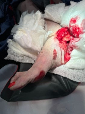 Figure 3. Open trimalleolar ankle fracture (Case 3)