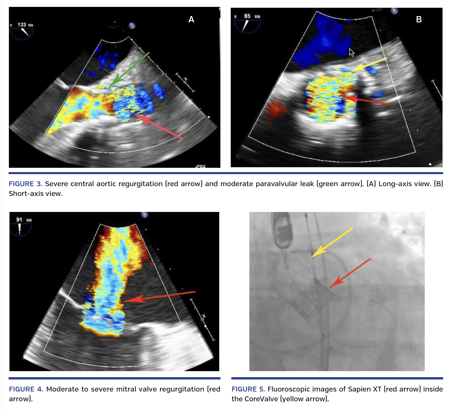 Severe central aortic regurgitation (red arrow) and moderate paravalvular leak (green arrow). (A) Long-axis view. (B) Short-axis view.