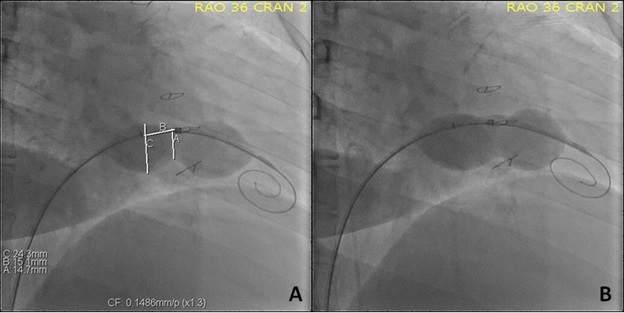Figure 3. Balloon sizing at baseline and post-dilation (case 1).