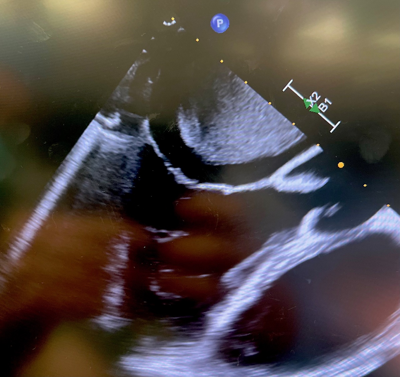 Figure 3. Intra-operative echo with myxoma.