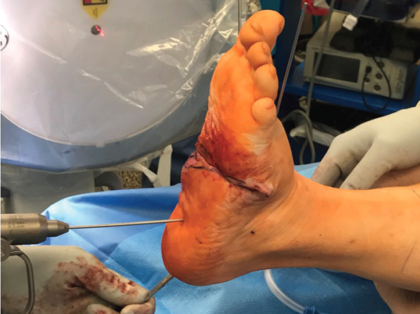 Here one can see the half pin “joystick” holding reduction of the rearfoot during transfixation pin placement from the plantar heel.