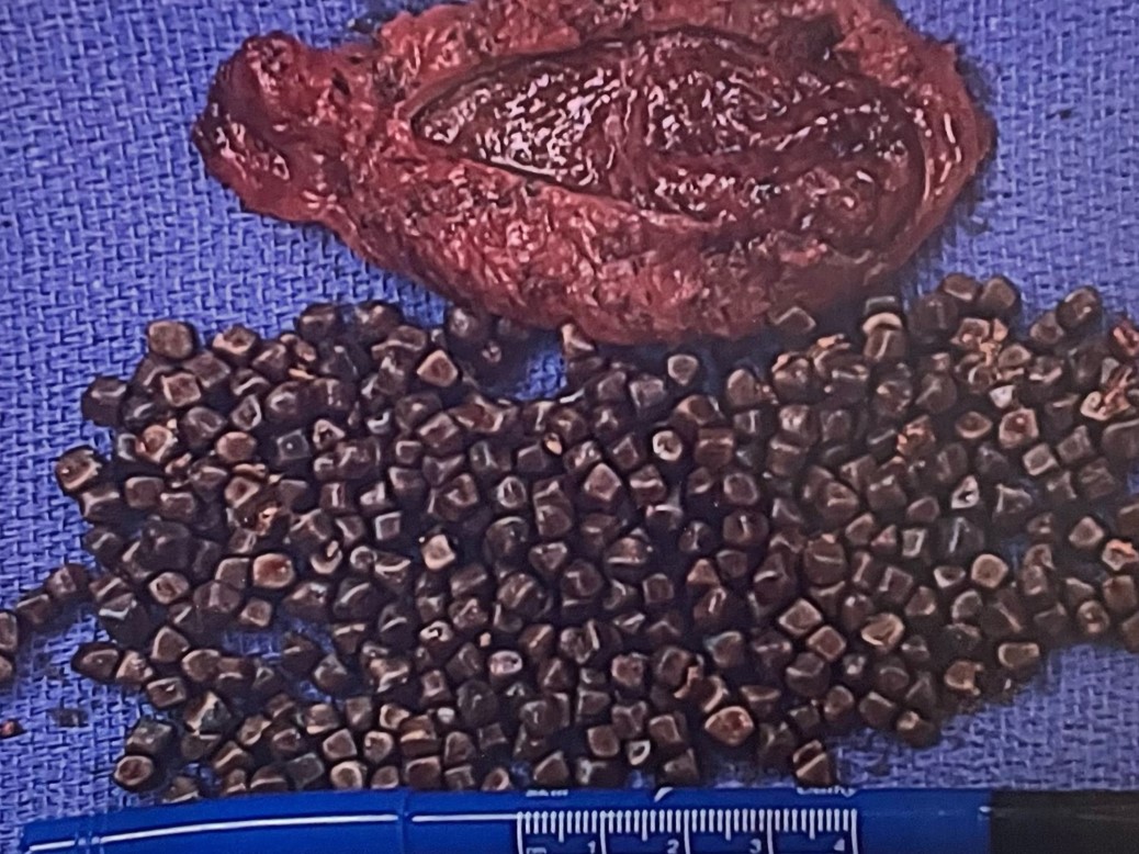 Figure 3: A pathologic image of a gallbladder with many gallstones (Photo: patient, used with consent) 