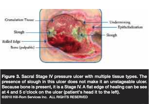 Figure 3 Sacral Stage IV pressure ulcer with multiple tissue types