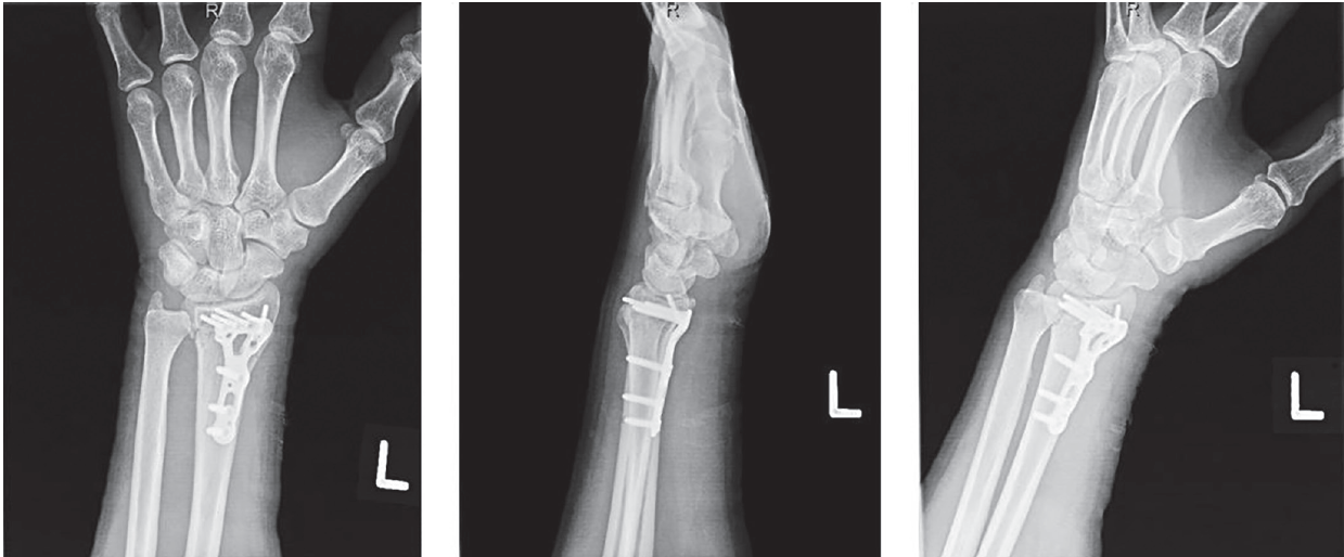 Figure 3 Siotos Distal Radius 
