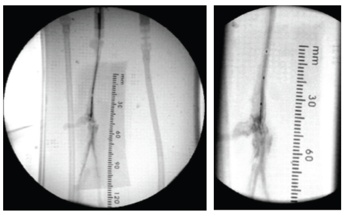 Recanalization was then attempted using the activated SoundBite Crossing System