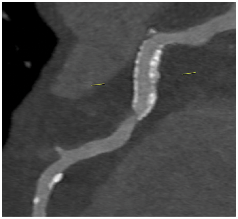 Figure 3. Severe occlusion of the native RCA distal to the stent.