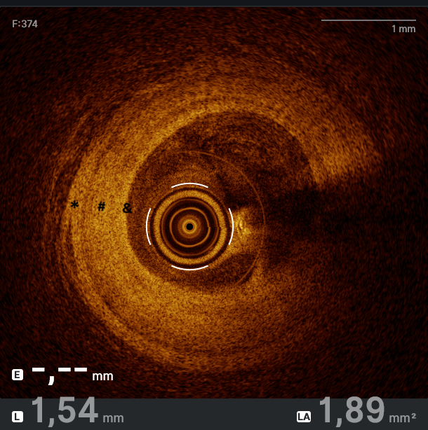 Figure 3. The chronic phase of vasculitis