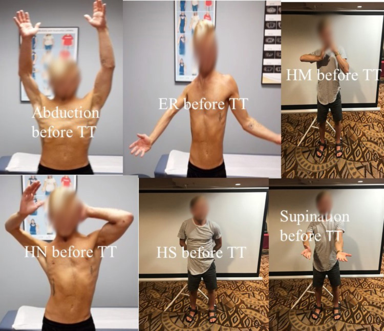 Figure 3. Modified Mallet movements of a 21-year-old man with OBPI before surgery.
